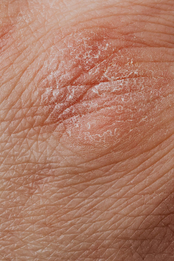 Dermatoscopes