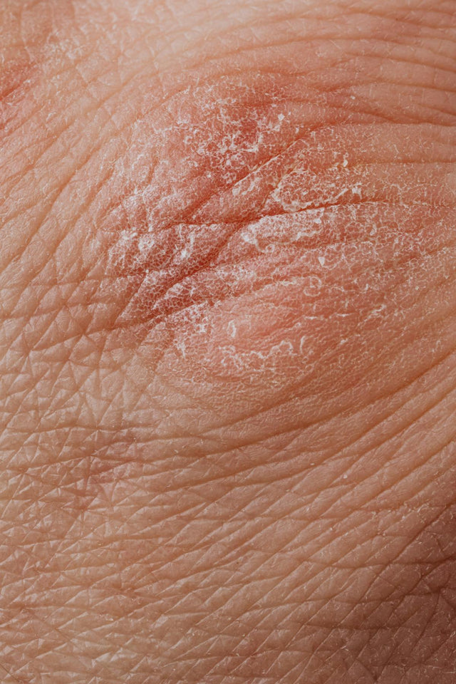 Dermatoscopes