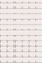 EKG-Papier f. Siemens Sicard 440, 148mmx25m